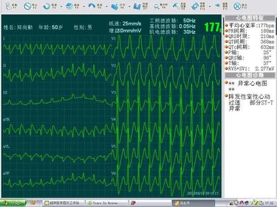 心电图生成器权威观点:拍一拍心电图符号大全更新观点
